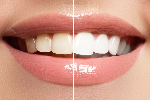 Brighten Your Smile: Teeth Whitening Tips