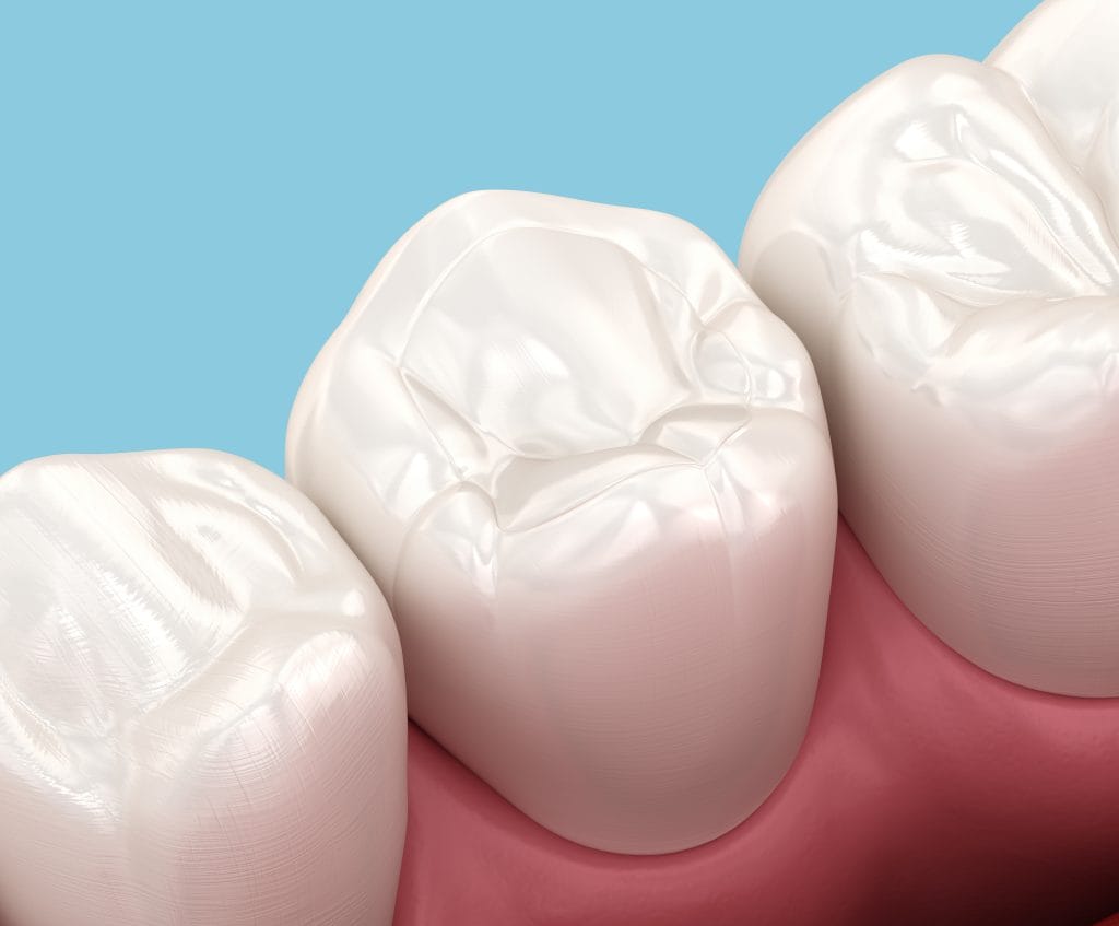 Metal-Free Dental Fillings in Sarasota