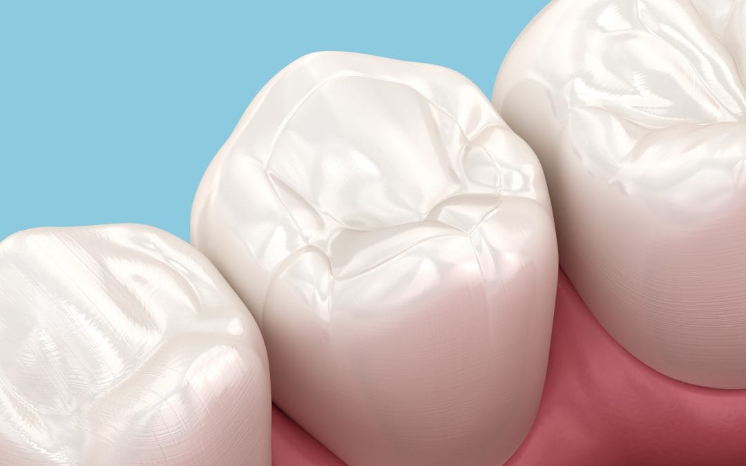 Why Metal Free Fillings Are a Healthier, Natural Choice