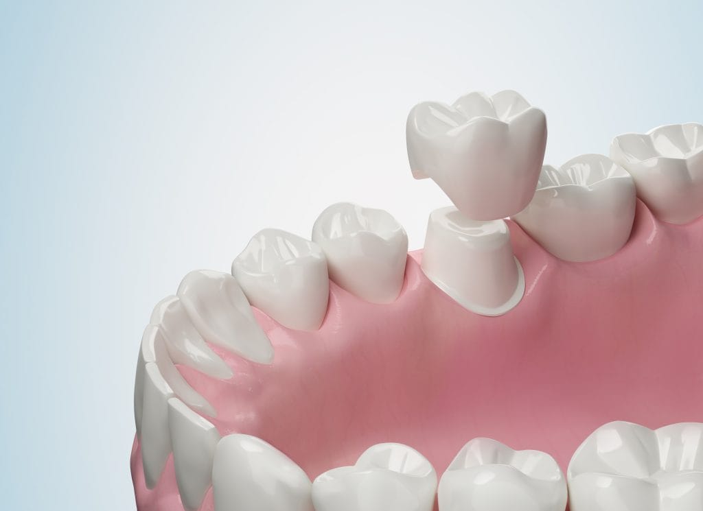 Cracked, Worn, or Weak Teeth? How Crowns, Inlays, and Onlays Restore Strength and Comfort