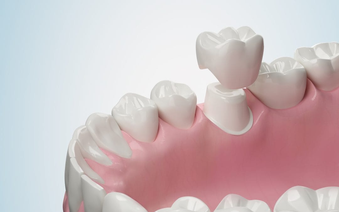 Cracked, Worn, or Weak Teeth? How Crowns, Inlays, and Onlays Restore Strength and Comfort