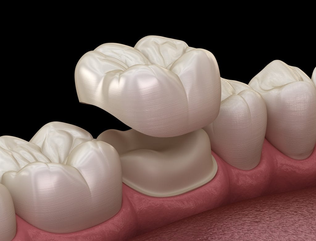 My Crown Feels Fine… So Why Did My Dentist Say It Might Need to Be Replaced?